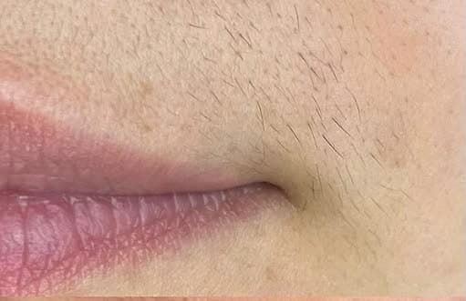 Antes de Depilação com linha