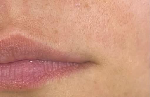 Depois de Depilação com linha