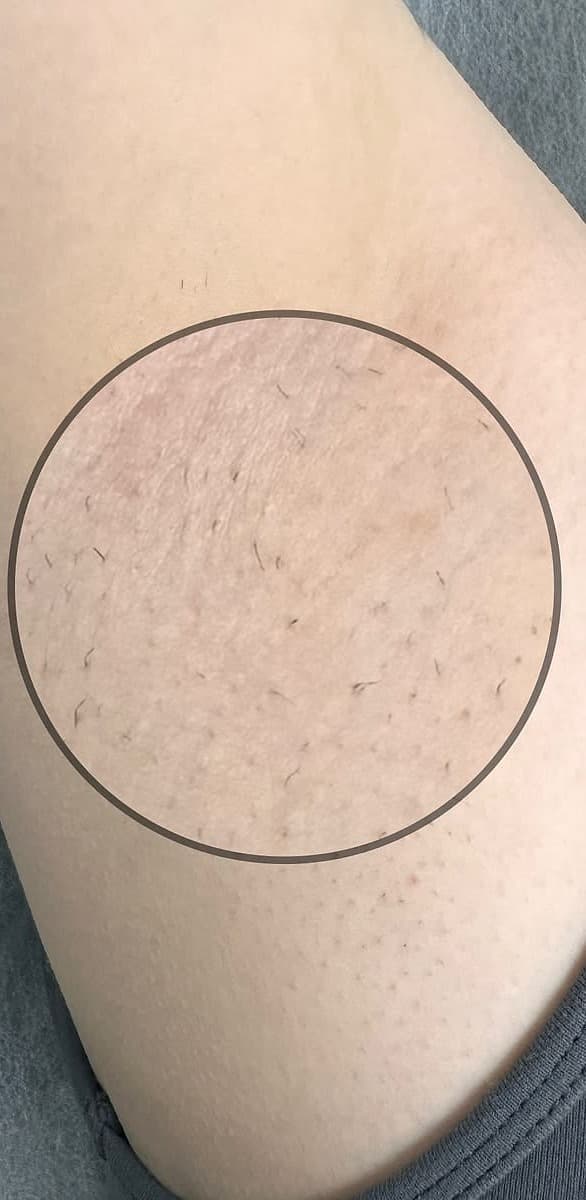 Depois de Depilação a laser